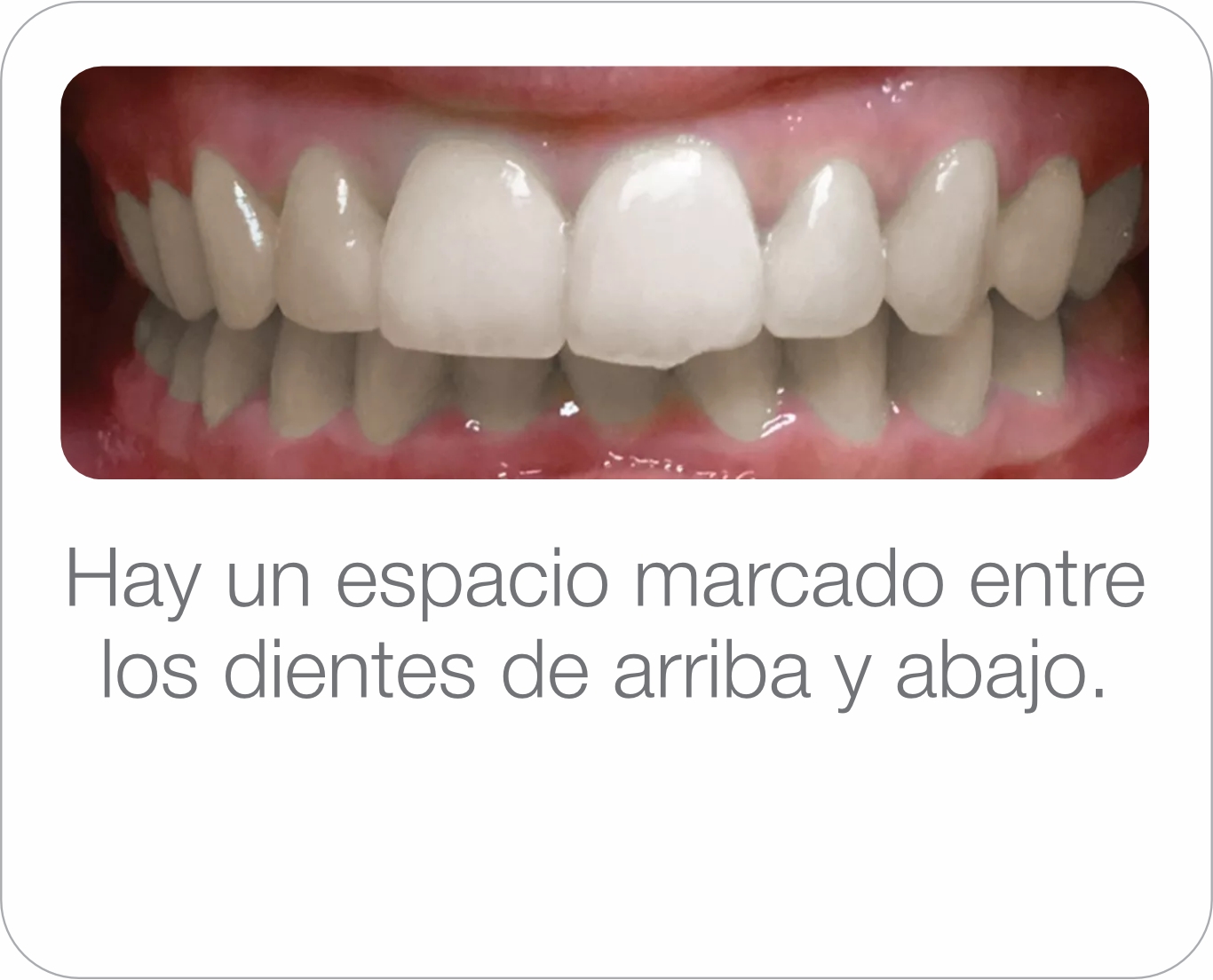 Caso real - Exceso de resalte